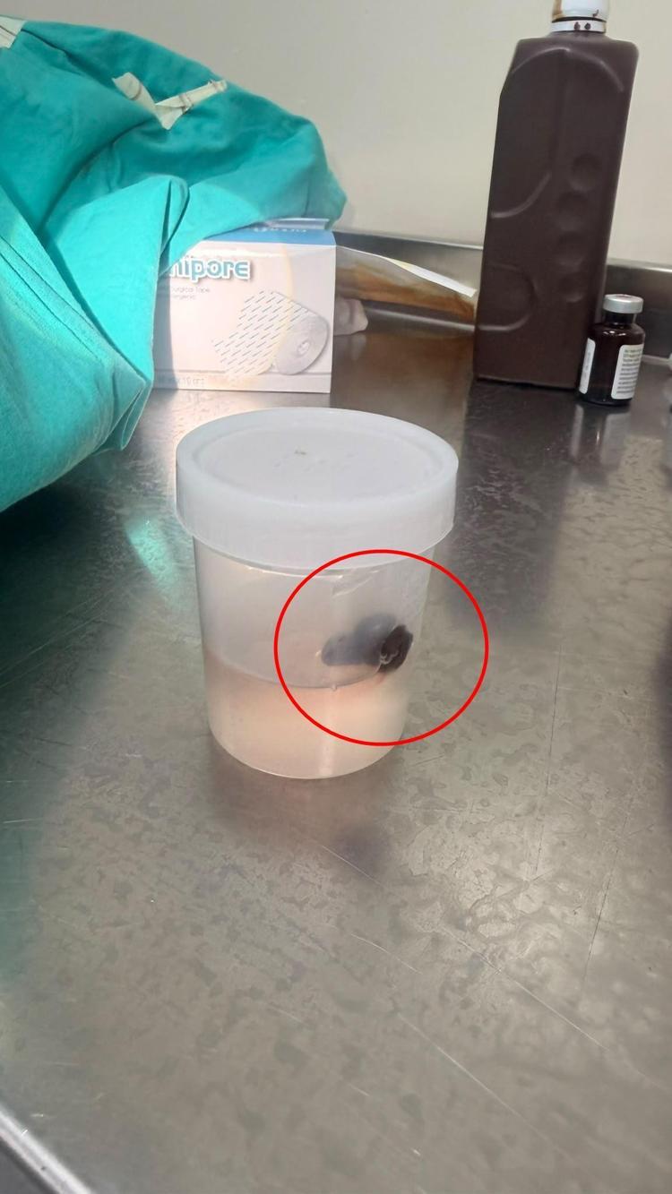 Siirt'te 10 yaşındaki çocuğun boğazından canlı sülük çıktı