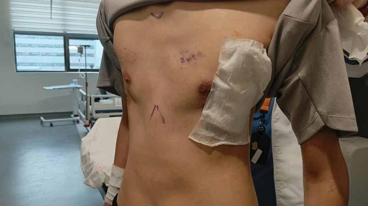 Samsun’da 17 yaşındaki hastanın göğsü ameliyatla düzeltildi